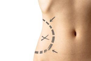 Female waistline about to perform vaser liposuction